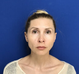 Beautiful 39-year-old lady with minor midface ptosis and minor skin laxity.