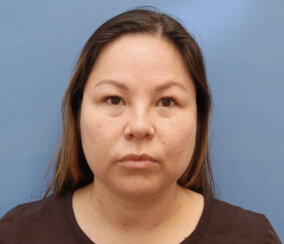 Endoscopic Brow Lift and Facelift