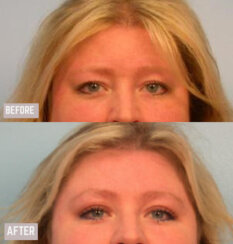 Endoscopic Brow Lift, Endoscopic Forehead Lift and Necklift