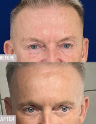 Endoscopic brow lift