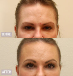 Endoscopic Brow Lift, Endoscopic Forehead Lift and Facelift