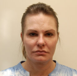 Endoscopic Brow Lift, Endoscopic Forehead Lift and Facelift