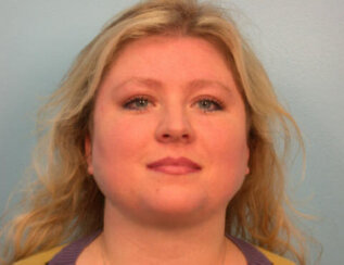 Endoscopic Brow Lift, Endoscopic Forehead Lift and Necklift