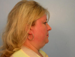 Endoscopic Brow Lift, Endoscopic Forehead Lift and Necklift