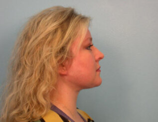 Endoscopic Brow Lift, Endoscopic Forehead Lift and Necklift