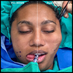 Minimally invasive midface suspension (MIMS)