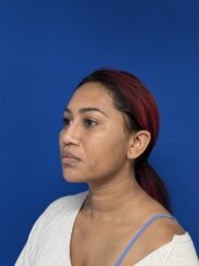 Minimally invasive midface suspension (MIMS)