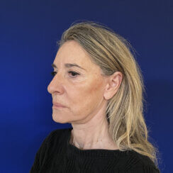 Face and Neck lifting procedures