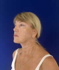 Facial Rejuvenation procedures.