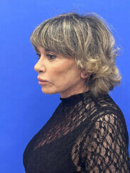 Revision facelift – Secondary facelift and associated face lifting procedures.