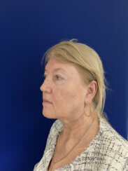 Facial Rejuvenation procedures.