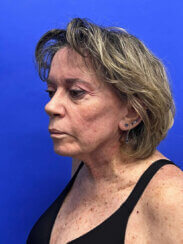 Revision facelift – Secondary facelift and associated face lifting procedures.