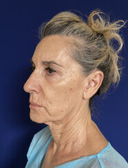 Face and Neck lifting procedures