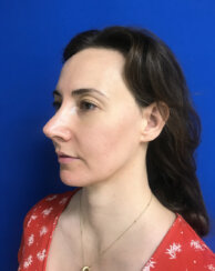 fat transfer to the following areas: under eyes, lips, chin and jawline.