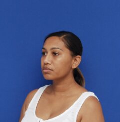 Minimally invasive midface suspension (MIMS)