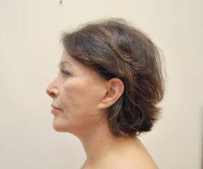 Multiple facelifting and rejuvenation procedures