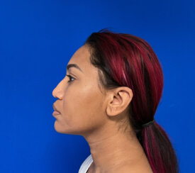 Minimally invasive midface suspension (MIMS)