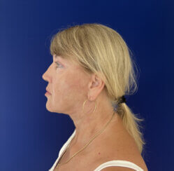 Facial Rejuvenation procedures.