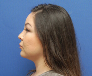 Endoscopic Brow Lift and Facelift