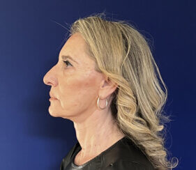Face and Neck lifting procedures