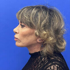Revision facelift – Secondary facelift and associated face lifting procedures.