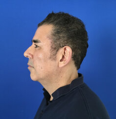 49-year-old male with moderate midface ptosis with skin laxity of the face.