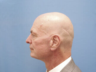 This gentleman had the following facelifting face lifting and neck lifting procedures