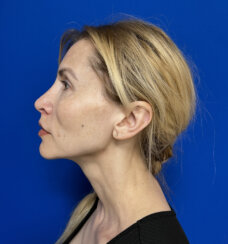 Beautiful 39-year-old lady with minor midface ptosis and minor skin laxity.