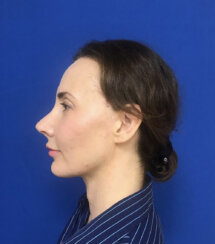 fat transfer to the following areas: under eyes, lips, chin and jawline.