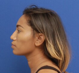 Minimally invasive midface suspension (MIMS)
