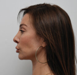 Endoscopic browlift