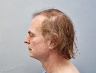 This gentleman had the following facelifting face lifting and neck lifting procedures