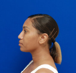 Minimally invasive midface suspension (MIMS)