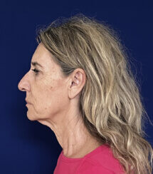 Face and Neck lifting procedures