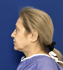 FaceLift and Upper Eyelid Surgery