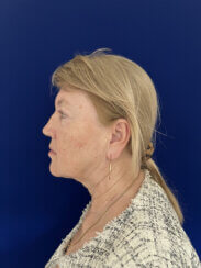 Facial Rejuvenation procedures.