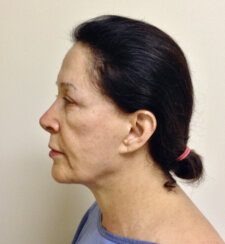 Multiple facelifting and rejuvenation procedures