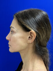 Revision facelift – Secondary facelift