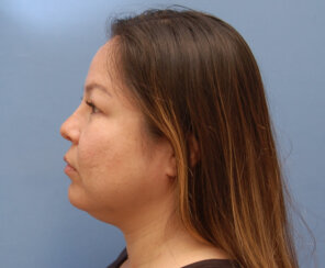Endoscopic Brow Lift and Facelift