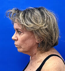Revision facelift – Secondary facelift and associated face lifting procedures.