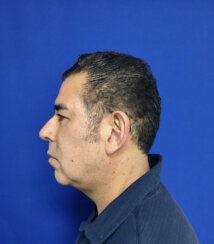 49-year-old male with moderate midface ptosis with skin laxity of the face.