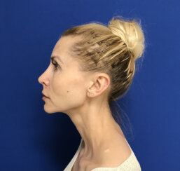 Beautiful 39-year-old lady with minor midface ptosis and minor skin laxity.