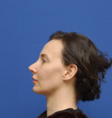 fat transfer to the following areas: under eyes, lips, chin and jawline.