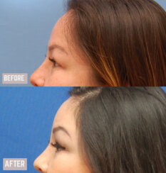 Endoscopic Brow Lift and Facelift