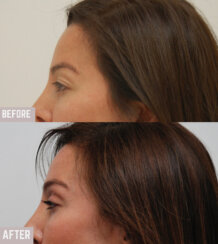 Endoscopic browlift