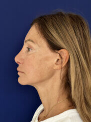 Revision facelift – Secondary facelift