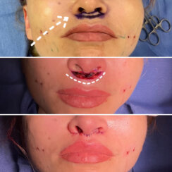 Beautiful 39-year-old lady with minor midface ptosis and minor skin laxity.
