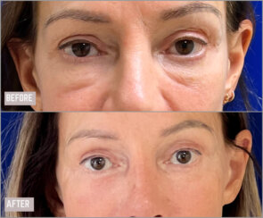 Revision facelift – Secondary facelift