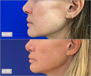 Revision facelift – Secondary facelift