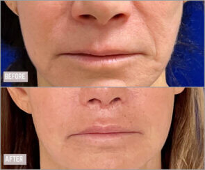 Revision facelift – Secondary facelift